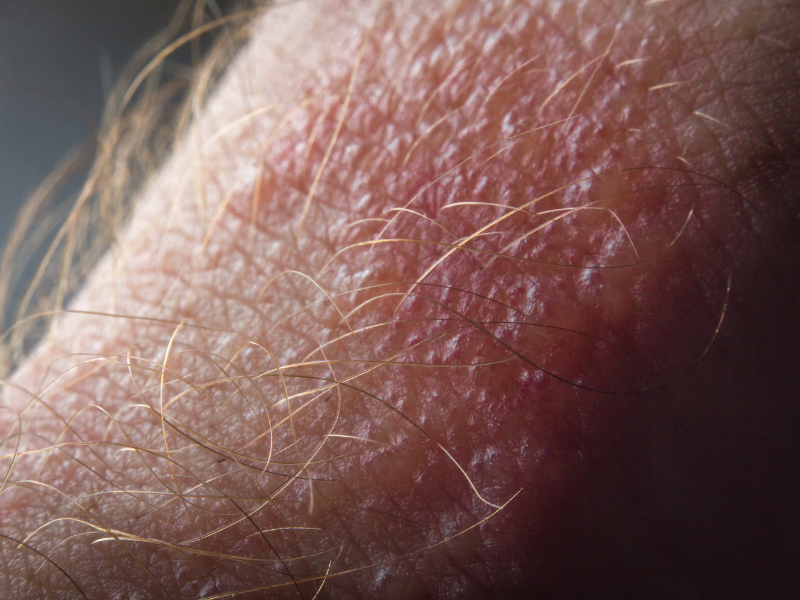 Itch antidote: The best essential oils for poison ivy